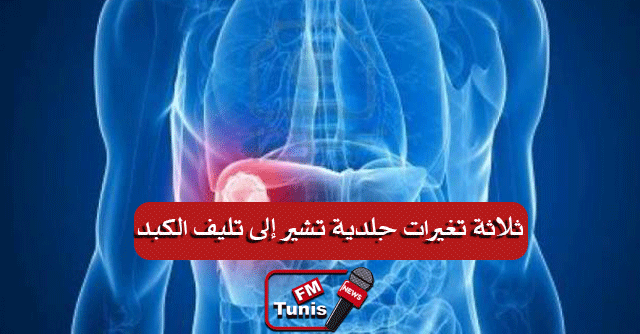 ثلاثة تغيرات جلدية تشير إلى تليف الكبد